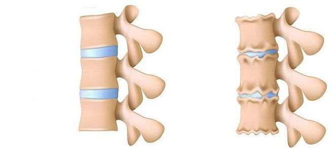 Osteochondrosis of the lumbar region