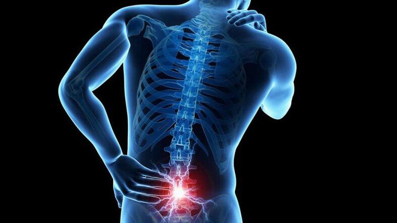 Symptoms of lumbar osteochondosis